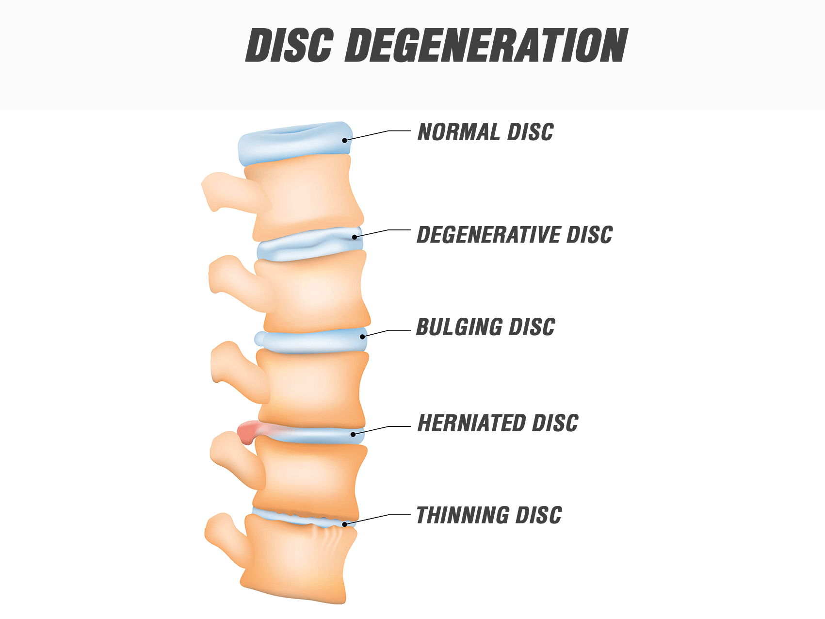 Degenerative Discopathie